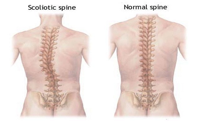 Adult Scoliosis in Los Angeles