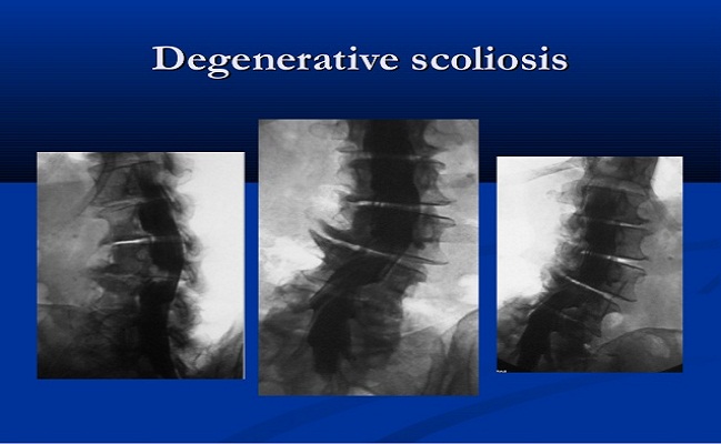 Adult Scoliosis in Beverly Hills
