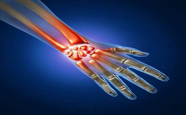 Carpal Tunnel Syndrome Los Angeles
