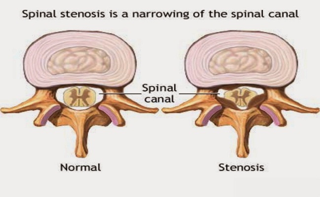 Spinal Stenosis Treatment in Los Angeles