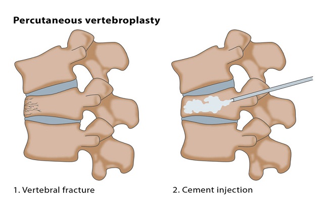 Vertebral Compression Fracture Treatment in Los Angeles
