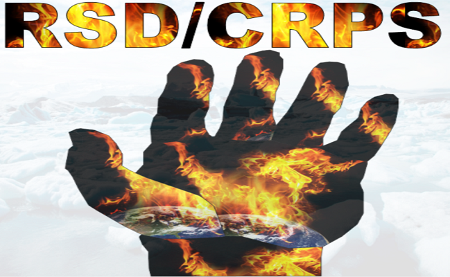CRPS and RSD Treatment in Beverly Hills