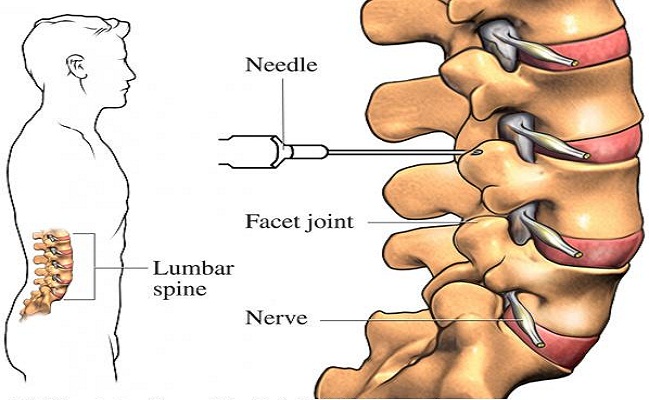 Facet Joint Syndrome Treatment in Beverly Hills