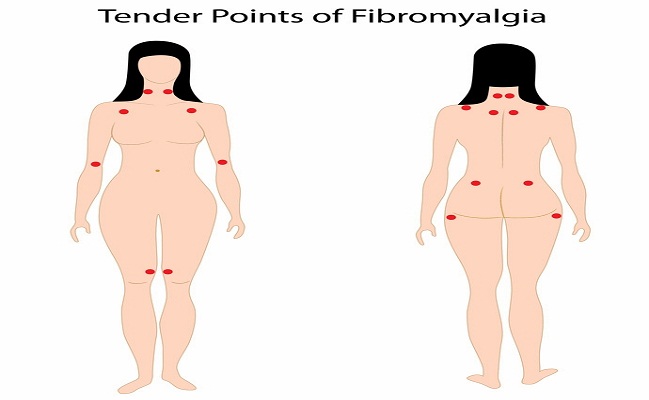 Fibromyalgia Treatment in Los Angeles