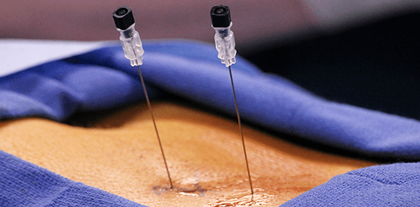 Epidural Steroid Injections in Los Angeles & Beverly Hills CA