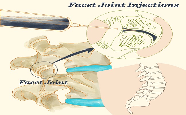 Facet Joint Injections in Beverly Hills