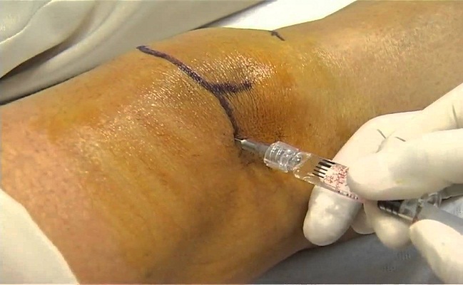 Knee Injections in Los Angeles