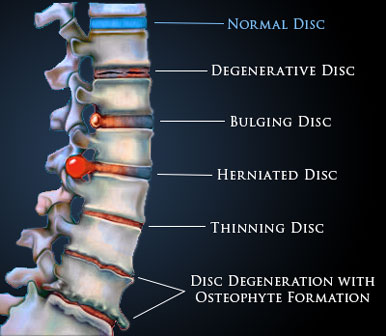 Bulging Disc Treatment With Pain Management Doctors in Los Angeles