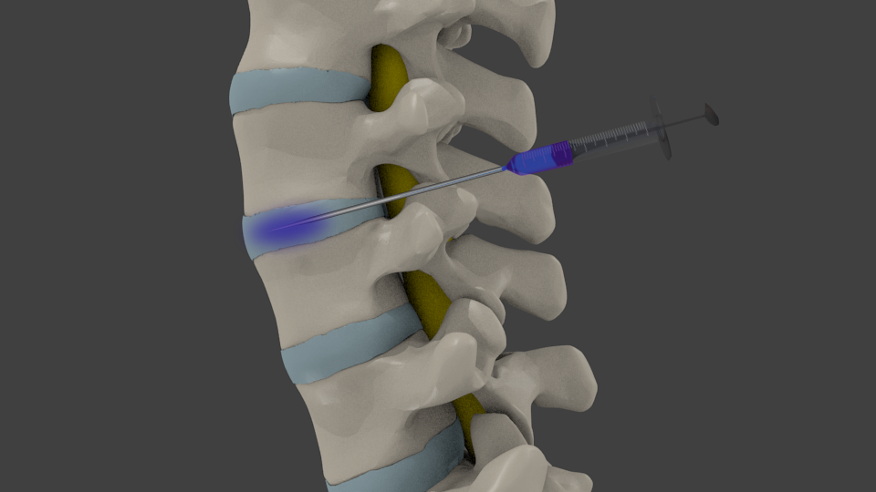 Lumbar Discogram in Los Angeles & Beverly Hills CA