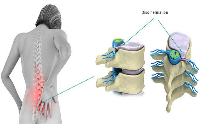 Bulging Disc Treatment With Pain Management Doctors in Beverly Hills
