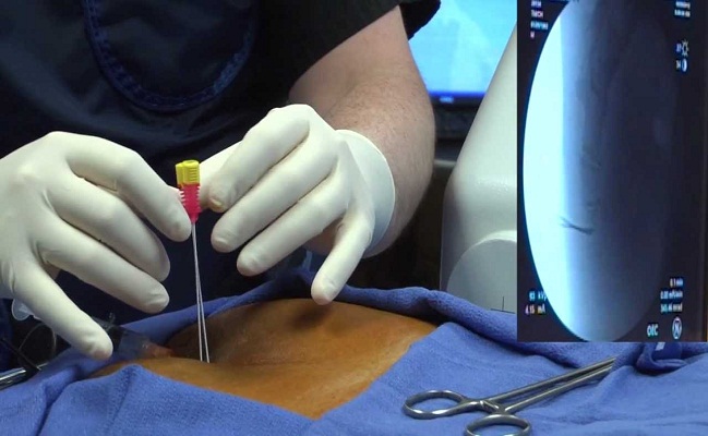 Radiofrequency Ablation in Beverly Hills