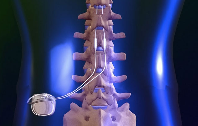 Spinal Cord Stimulator Implant in Los Angeles & Beverly Hills CA