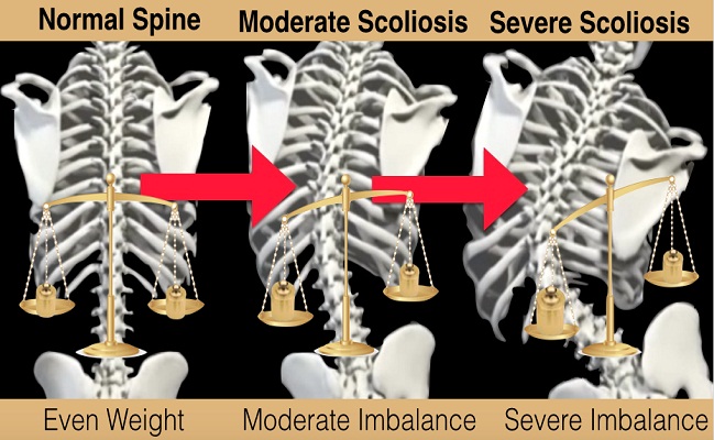 Painful Adult Scoliosis Treatment in Beverly Hills
