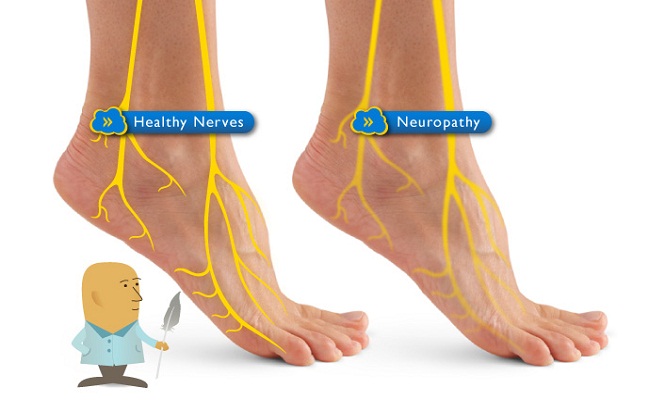 Peripheral Neuropathy from a Beverly Hills Pain Doctor