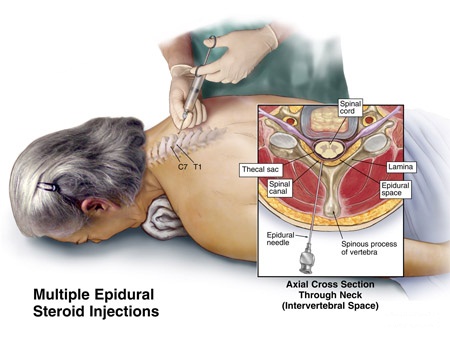 Epidural Steroid Injection in Beverly Hills