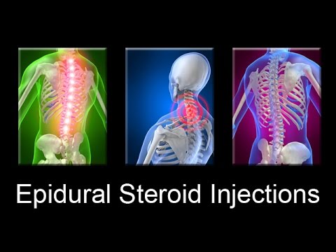 Epidural Injections for Pain Relief Los Angeles & Beverly Hills CA