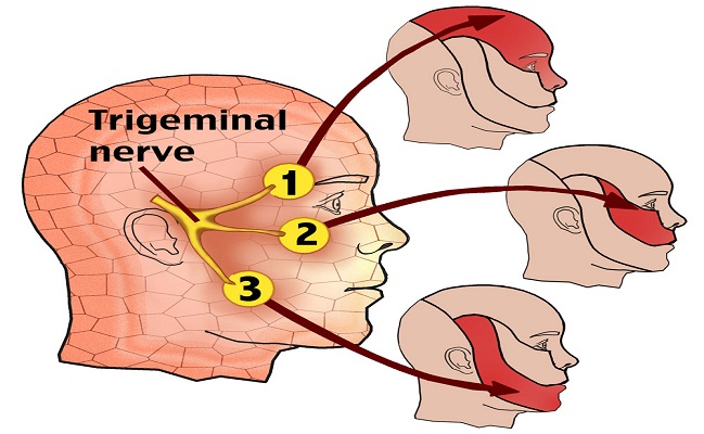 Trigeminal Neuralgia top Pain Clinic Beverly Hills