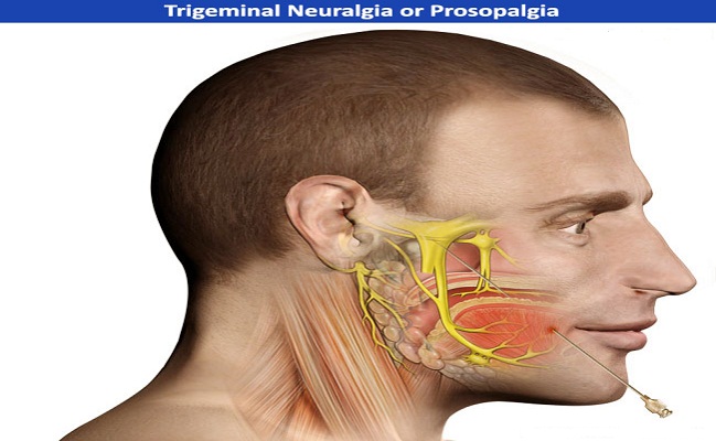 Trigeminal Neuralgia top Pain Clinic in Beverly Hills