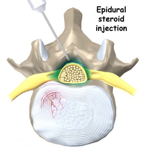 Epidural Steroid Injection Los Angeles & Beverly Hills