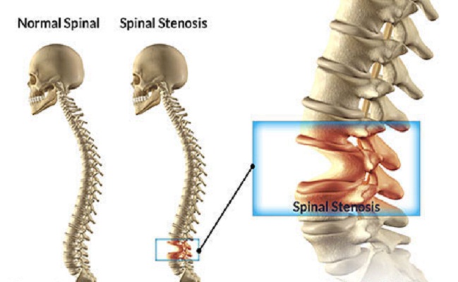 Top Spinal Stenosis Treatment Beverly Hills