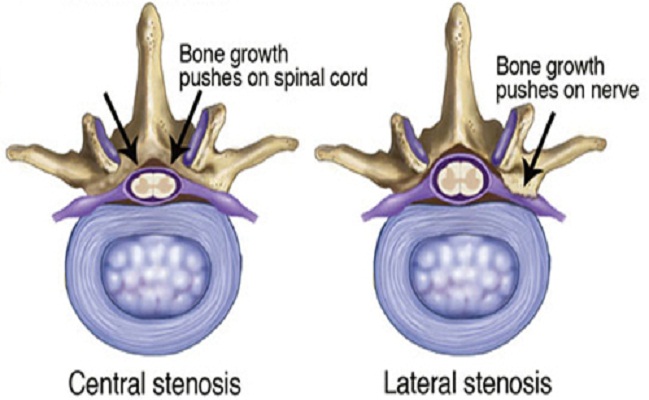 Top Spinal Stenosis Treatment Los Angeles