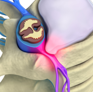 Percutaneous Discectomy for Sciatica and Back Pain Relief in Los Angeles & Beverly Hills