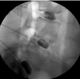 Lumbar Discogram Los Angeles