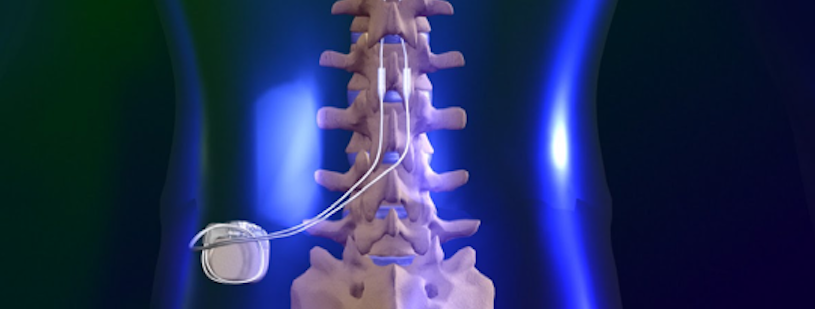 Stimulator Spinal Cord Stimulator Los Angeles